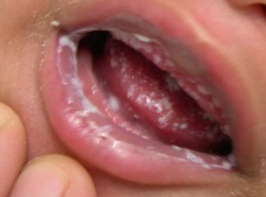 Кандидоз в полости рта
