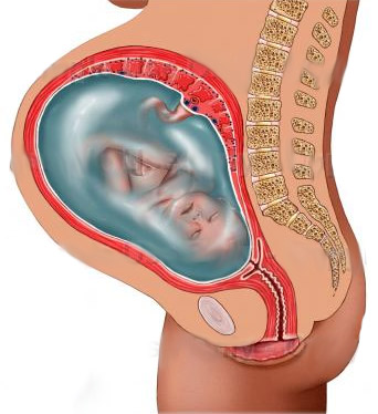 Лечение многоводия при беременности — обязательное условие для сохранения здоровья плода Лечение многоводия при беременности