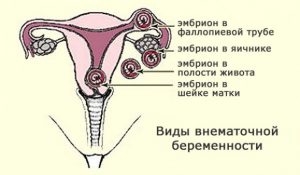 Внематочная беременность на ранних сроках