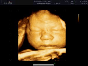 На сроке беременности 21 неделя можно провести и 3D-узи