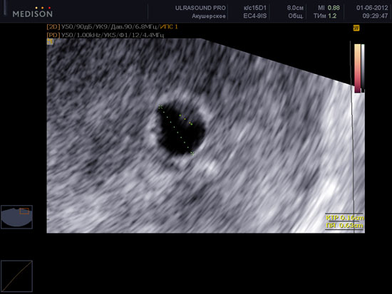 УЗИ в 4 недели беременности — что покажет и для чего его делать? Узи в 4 недели беременности - это, как правило, первое ультразвуковое исследование