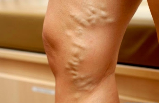 Что делать, если возник варикоз при беременности? Варикоз при беременности - достаточно частое явление