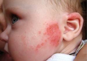 Как лечить диатез у грудничков и что для этого нужно делать? Когда возникает диатез у грудничков, лечение просто необходимо