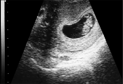 Зачем проводить УЗИ-исследование на 8 неделе беременности? УЗИ на 8 неделе беременности не входит в список плановых обследований