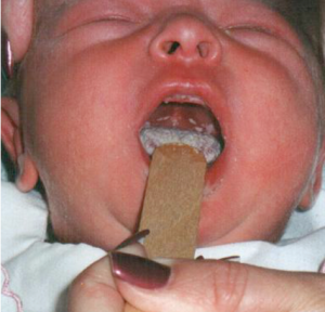 Молочница у новорожденных во рту сопровождается довольно явными симптомами