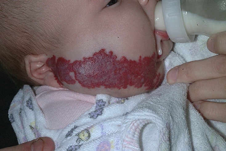 Гемангиома у новорожденных: что это и как лечится? Гемангиома у новорожденных - это доброкачественная опухоль