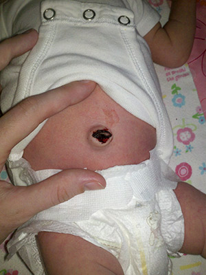 Кровит пупок у новорожденного: почему и что делать? Если пупок у новорожденного кровит, нужно показать ребенка врачу