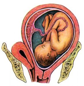 Выворот матки при родах происходит по разным причинам