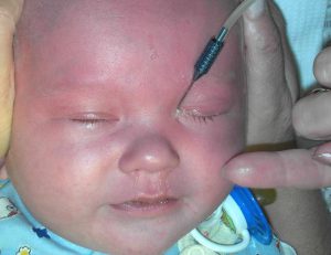 Зондирование слезного канала у новорожденного назначается в сложных случаях