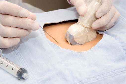 Биопсия ворсин хориона: что это, для чего и чем опасно? Биопсия ворсин хориона проводится по серьезным показаниям