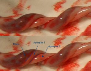 в норме в пуповине присутствуют три кровеносных сосуда