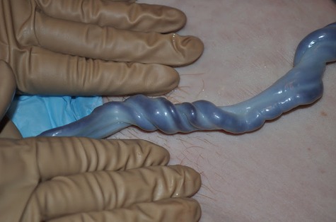 Пуповина: сколько сосудов она должна иметь и чем опасны аномалии? При беременности важно знать, сколько сосудов должна иметь пуповина