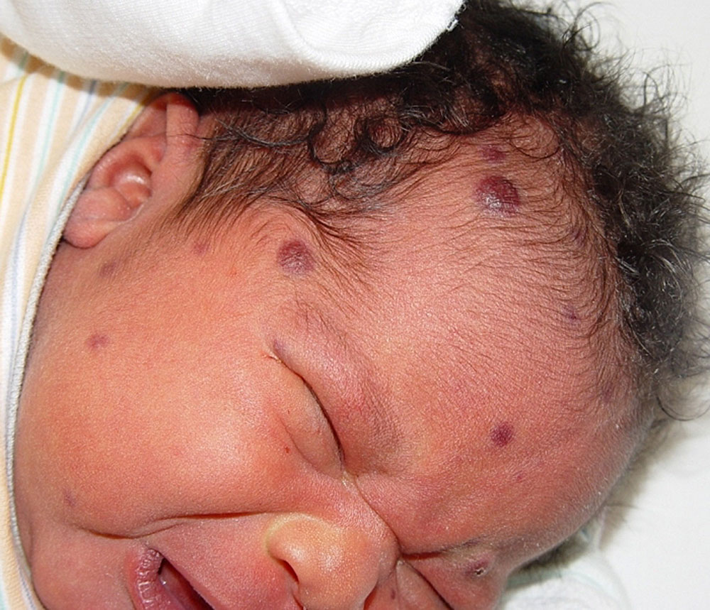 Симптомы, признаки и лечение цитомегаловирусной инфекции у детей Цитомегаловирусная инфекция у детей - достаточно опасное заболевание