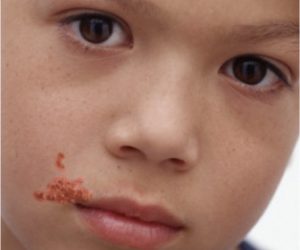 Инфекционный мононуклеоз у детей може иметь серьезные последствия