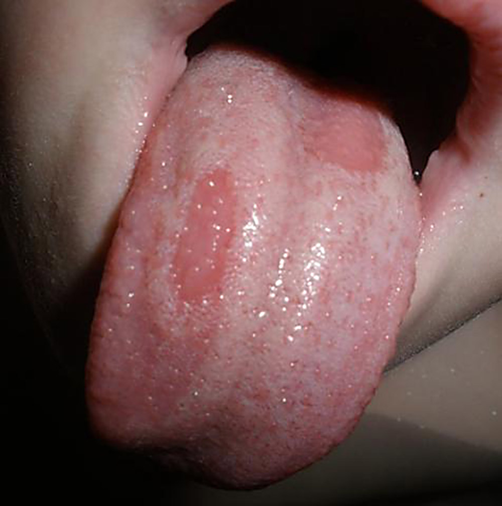 Что такое географический язык и почему он бывает у ребенка Географический язык у ребенка