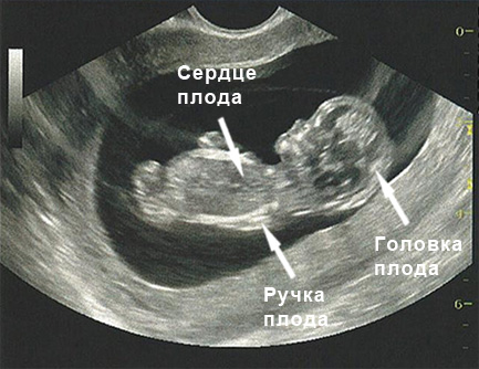 УЗИ на 11 неделе беременности