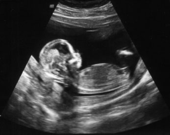 Фото УЗИ плода на 12 неделе беременности