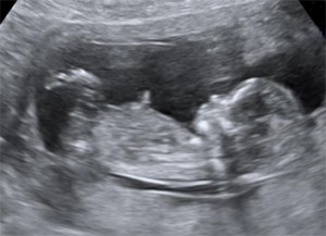 Узи ребенка на 13 неделе. УЗИ плода на 13 неделе беременности. 13 Недель беременности фото плода на УЗИ. УЗИ 13 недель беременности пол. Ребенок на 13 неделе беременности УЗИ.