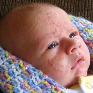 Как отличить акне новорожденных от аллергии