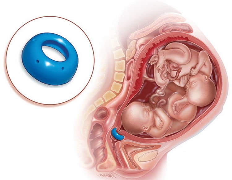 пессарий при многоплодной беременности