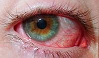 воспаление глаза симптомы