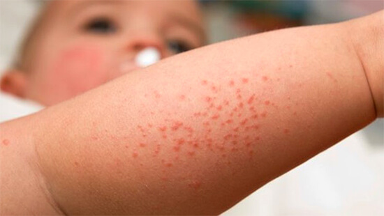 Аллергия на антибиотики у ребенка — фото сыпи от приема лекарств, лечение