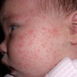 как узнать есть ли у ребенка аллергия
