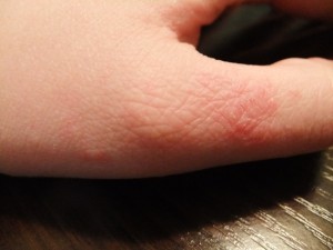 Латексная аллергия фото 3