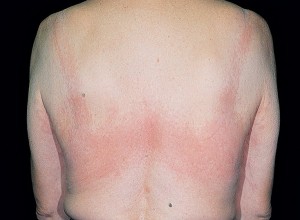 Латексная аллергия фото 4