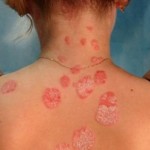 аллергия на лак для волос симптомы