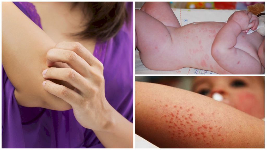 Аллергия на средство от насекомых