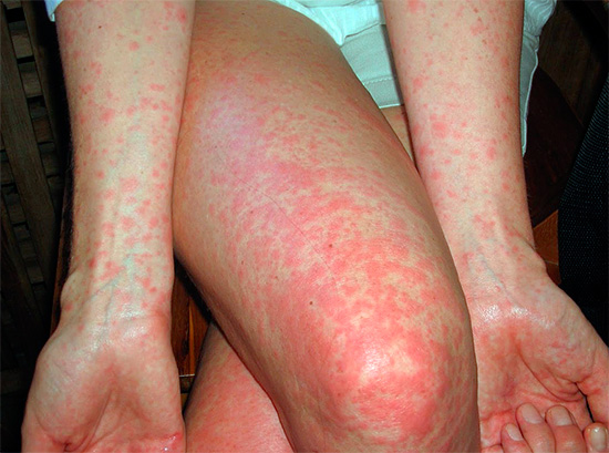 Аллергия на укус насекомого может проявляться и в виде мелкой сыпи по всему телу или на отдельных участках.