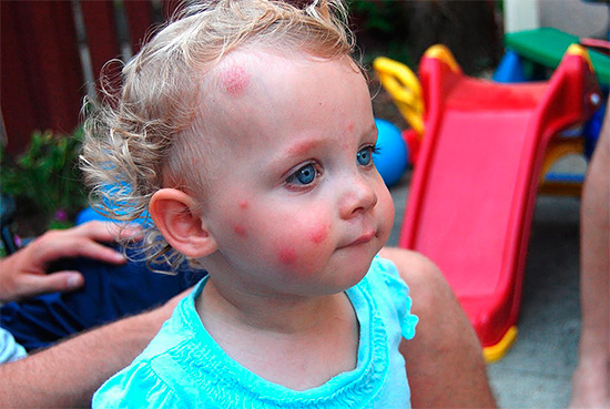 Следы от укусов насекомых на лице ребенка