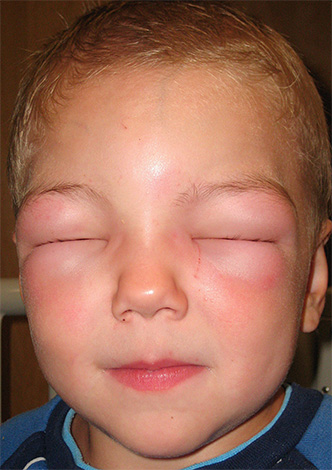 При развитии у ребенка тяжелой аллергической реакции следует немедленно обратиться за помощью к врачу.