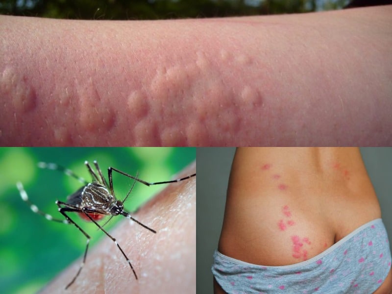 Аллергия на укусы комаров у детей фото симптомы