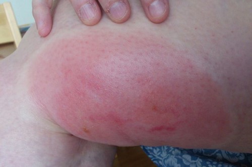 аллергия на укус комара