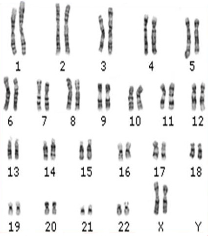 Анализ на кариотип: что это такое и для чего проводится кариотипирование?