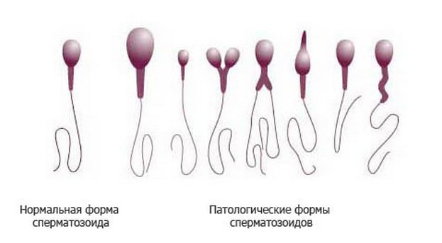 Норма и отклонения в форме сперматозоидов