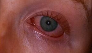вирусный конъюнктивит женских глаз