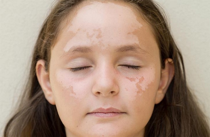 Белое пятно на коже у ребенка: фото на лице, причины и лечение возможных заболеваний