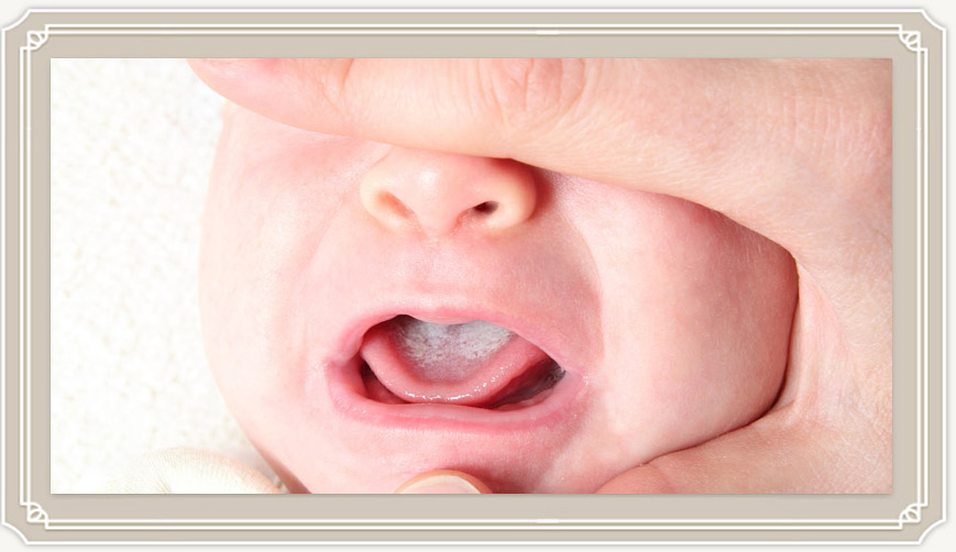 Белый налет на языке у грудничка на грудном вскармливании (во рту у ребенка)