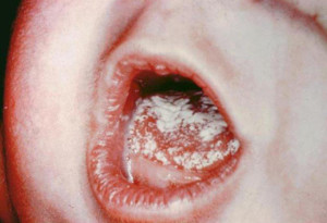 молочница налет у грудного ребенка во рту