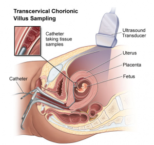 Биопсию хориона проводят в период с 11 по 14 неделю беременности