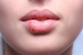 Почему появляется герпес на губах и его лечение
