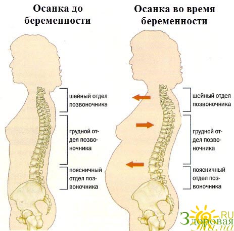 изменения осанки во время беременности