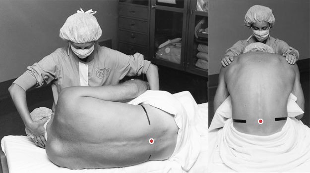 Варианты положения пациента для выполнения спинальной анестезии — лежа на боку и сидя. Черные линии условно показывают уровень, на котором будет выполнена пункция, а красная точка — само место пункции. Оригиналы изображений взяты здесь.