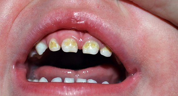 Бутылочный кариес у детей — фото и причины, лечение по Комаровскому