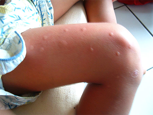 Особенно хорошо гель Фенистил помогает, например, при укусах постельных клопов, блох, комаров и мошек.