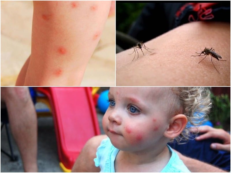 укусы комаров у детей фото аллергической реакции
