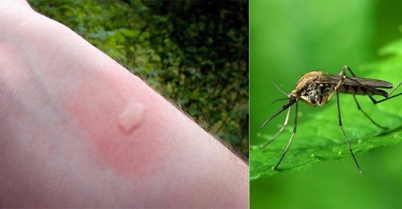 укусы комаров у детей фото основные симптомы
